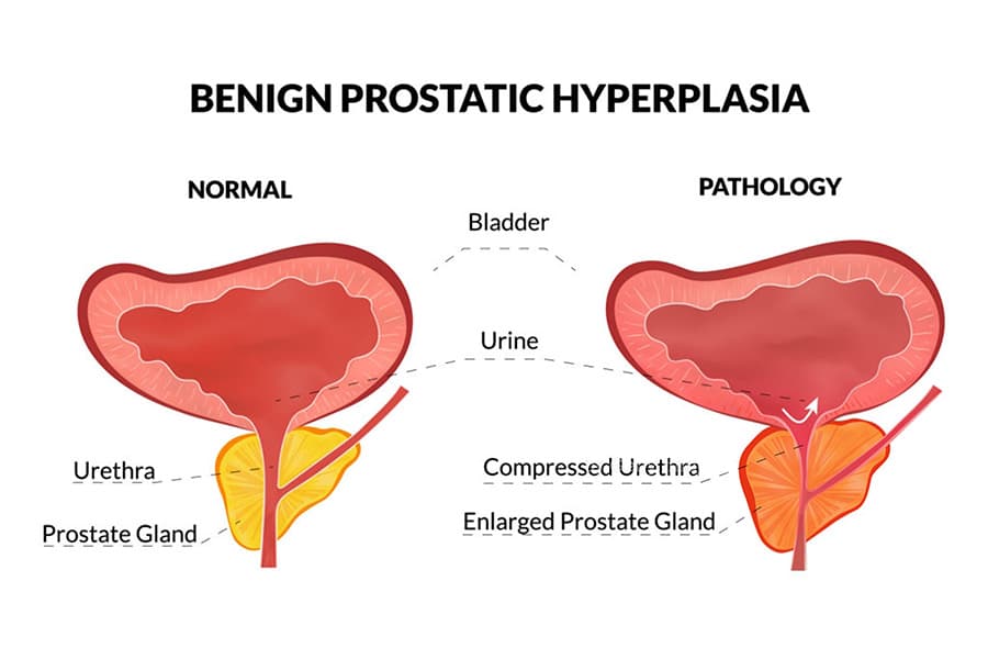 case study of benign prostatic hyperplasia