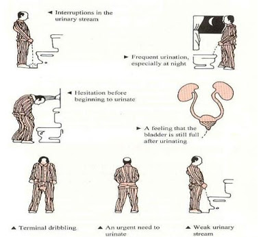 Bph symptoms