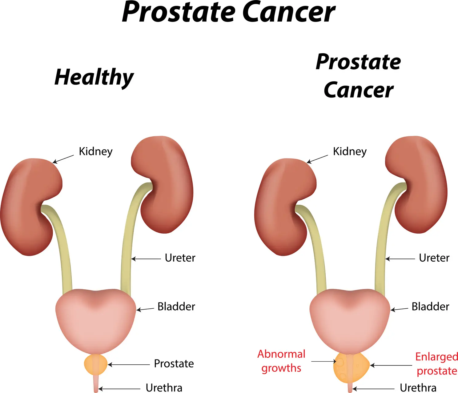 Multivitamin use may reduce prostate Ca recurrence