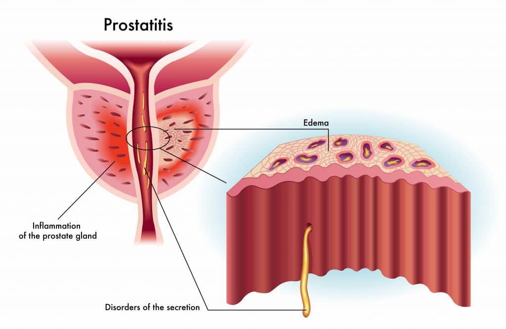 Prostatitis Prostate Gland Inflammation Urology Of Virginia