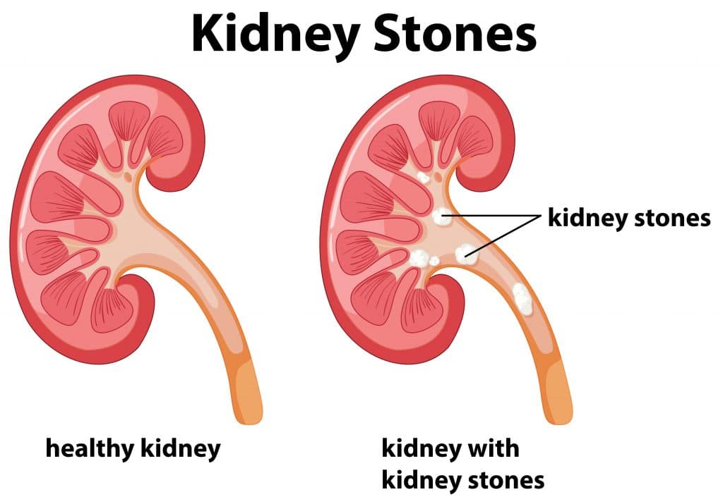 prostatitis vagy urolithiasis adenom de prostata cauze si simptome