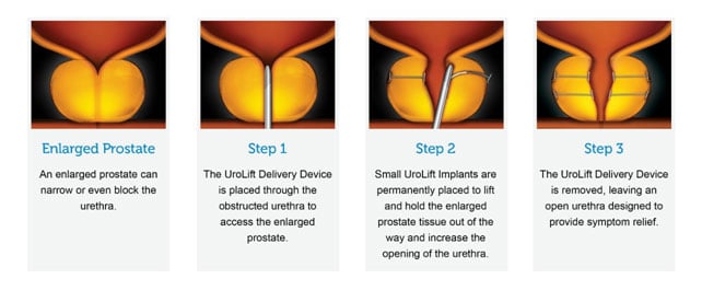 UroLift® System