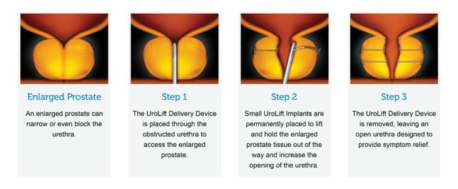 uroLift